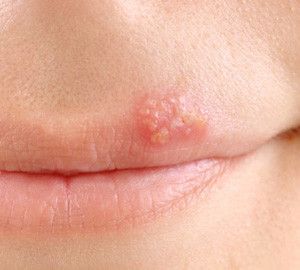 Can You Put a Pimple Patch on a Cold Sore & What Happens if You Do?