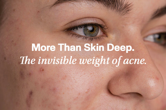 acne anxiety and depression