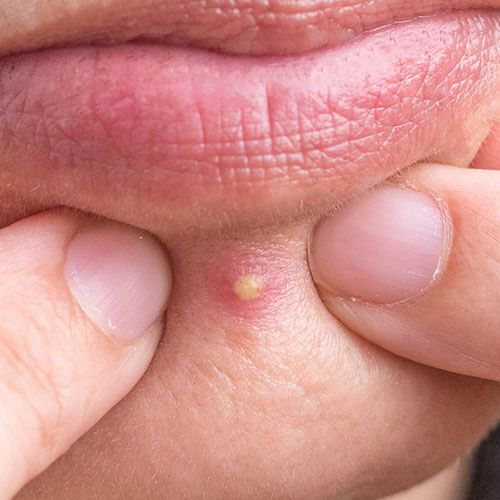Can You Put a Pimple Patch on a Popped Pimple & Will it Work?