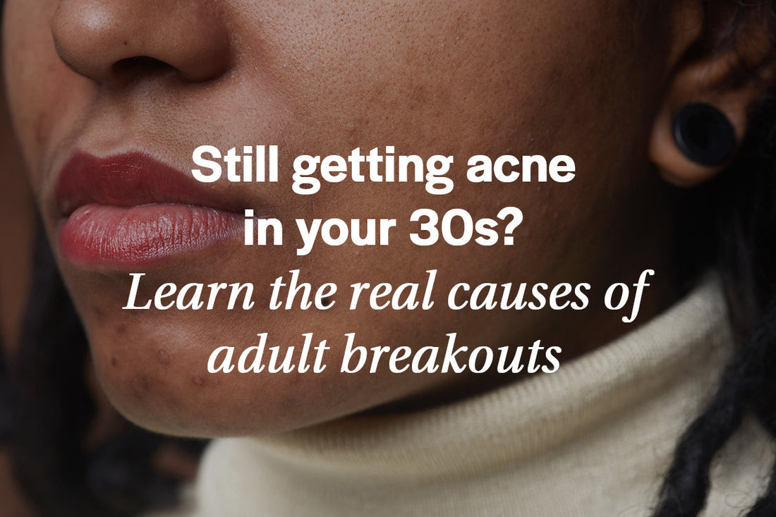 causes of adult acne