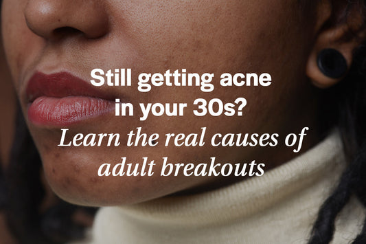 causes of adult acne