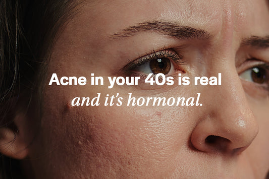 adult acne