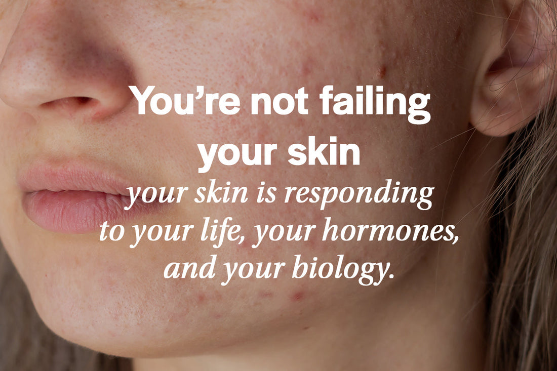 adult acne